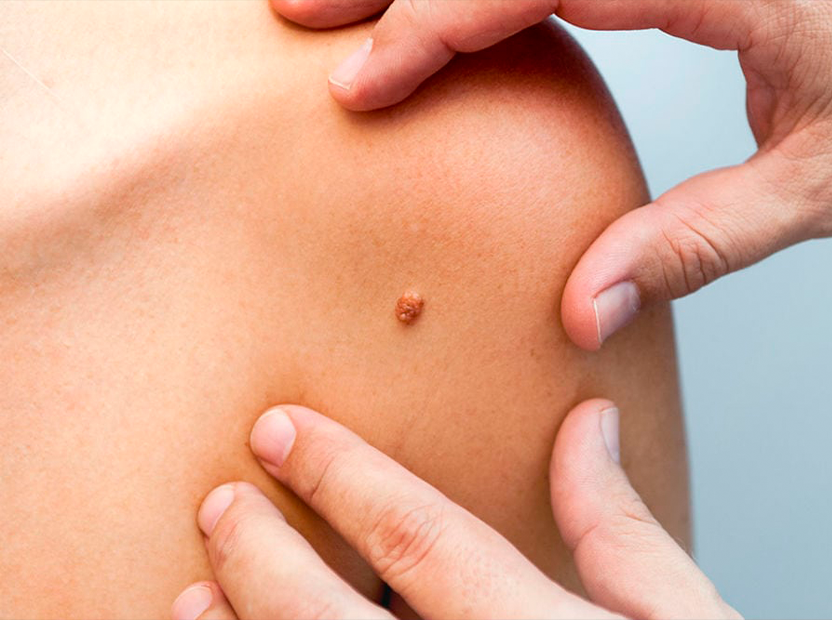 Почему важно прививаться от вируса папилломы человека